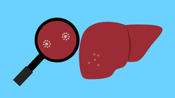 Viêm gan bí ẩn​ là gì? Triệu chứng, nguyên nhân, chẩn đoán, điều trị và phòng ngừa 2