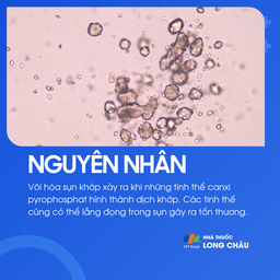 Vôi hóa sụn khớp 3