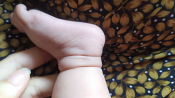 Vòng thắt chi bẩm sinh 1