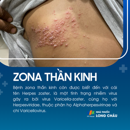 Bệnh zona thần kinh do virus Varicella-zoster