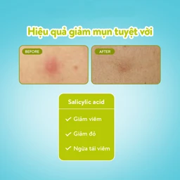 Miếng dán mụn ban ngày Derma Angel Plus (12 miếng) hút dịch mủ, làm lành vết thương nhanh chóng