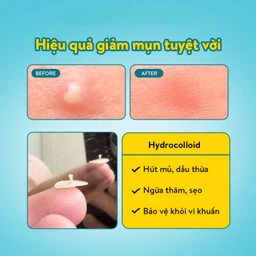 Miếng dán mụn ban ngày Derma Angel (12 miếng) hút mụn, làm lành vết thương sau mụn 