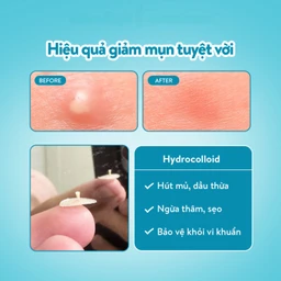 Miếng dán mụn ban ngày và đêm Derma Angel (12Đ + 6N miếng) hút mụn, làm lành vết thương sau mụn 