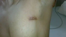 Lao vú là gì? Nguyên nhân, triệu chứng và các phương pháp phòng ngừa 3