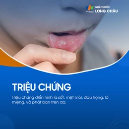 Dấu hiệu tay chân miệng thường bắt đầu bằng sốt, mệt mỏi, đau họng, chán ăn, chảy nước dãi