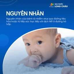 Nguyên nhân chính gây bệnh tay chân miệng là do các loại virus đường ruột, chủ yếu là Coxsackievirus A16 và Enterovirus 71