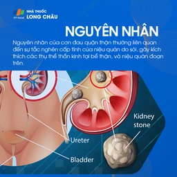 Nguyên nhân đau quặn thận - Sỏi thận và các yếu tố gây cơn đau quặn thận