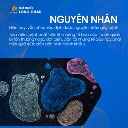 ung thư thanh quản 3