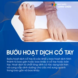 Bướu Hoạt Dịch Cổ Tay 1