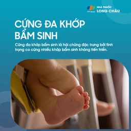 Cứng Đa Khớp Bẩm Sinh 1