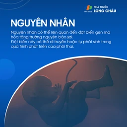 Chứng dính liền khớp sọ sớm 3