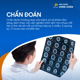 Chứng dính liền khớp sọ sớm 5