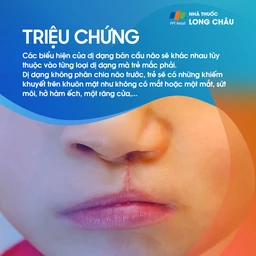 Dị dạng bán cầu não 2