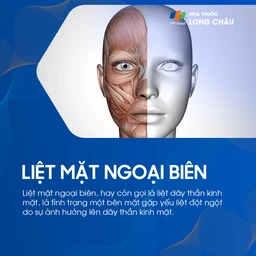 Liệt mặt ngoại biên 1