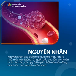 Nguyên nhân gây bệnh nhồi máu não chủ yếu do tắc nghẽn mạch máu trong nã