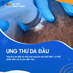 Ung thư da đầu 1