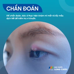  Viêm bờ trên mi mắt là gì? Nguyên nhân, triệu chứng và cách điều trị 5