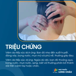 Triệu chứng viêm da do tiếp xúc với da đỏ, ngứa và phát ban