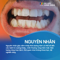 Viêm khớp thái dương hàm 3