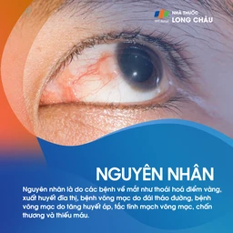 Xuất huyết võng mạc 3