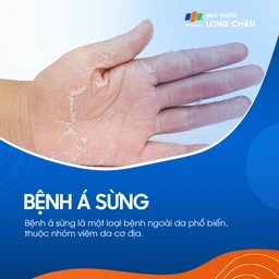 Bệnh á sừng là bệnh ngoài da phổ biến, thuộc nhóm viêm da cơ địa