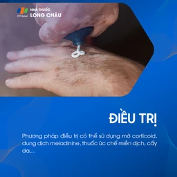 Điều trị bạch biến có thể dùng corticoid, dung dịch meladinine, thuốc ức chế miễn dịch, cấy da