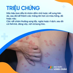 Các vết da bị viêm đỏ, ngứa và có hình tròn hoặc bầu dục, thường xuất hiện trên cánh tay và chân