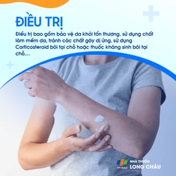 phương pháp điều trị bao gồm sử dụng kem corticosteroid tại chỗ, kem dưỡng ẩm và thay đổi lối sống