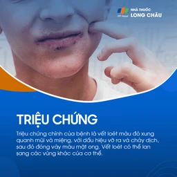 Vết loét đỏ quanh mũi, miệng – dễ vỡ, chảy dịch rồi đóng vảy màu mật ong, có thể lan sang vùng khác
