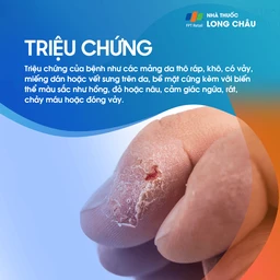 Dày sừng ánh sáng2