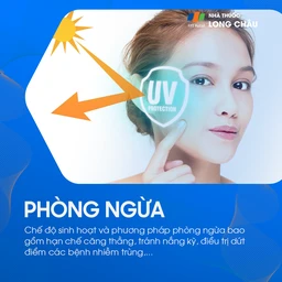 Tránh nắng là biện pháp phòng ngừa lupus ban đỏ