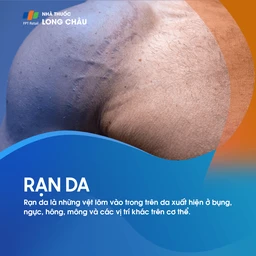 Rạn da (đường vân) là những vệt lõm vào trong xuất hiện trên bụng, ngực, hông, mông