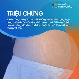 các vết rạn da đỏ hồng và trắng trên da bụng, điển hình ở phụ nữ mang thai