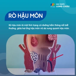 Rò hậu môn 1