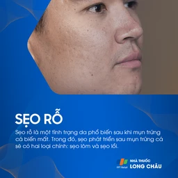 Sẹo rỗ trên mặt là hậu quả của mụn trứng cá, biểu hiện rõ ràng qua các lỗ nhỏ trên da