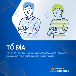 Tổ đỉa - Dyshidrotic eczema là một tình trạng viêm da thường gặp, biểu hiện bởi các mụn nước