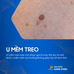 U Mềm Treo 1