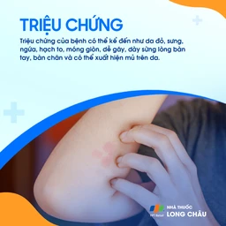 U sùi thể nấm 2