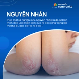 Nguyên nhân vảy nến liên quan đến phản ứng miễn dịch quá mức của tế bào T trong lớp thượng bì