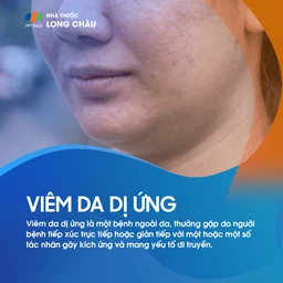Viêm Da Dị Ứng 1