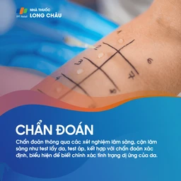 Viêm Da Dị Ứng 6