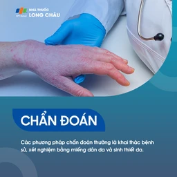 Phương pháp xét nghiệm và chẩn đoán viêm da Khai thác bệnh sử để tìm hiểu các nguyên nhân có thể có dẫn đến viêm da