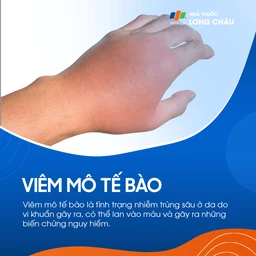 Viêm Mô Tế Bào 1