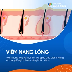 Viêm nang lông là một tình trạng da phổ biến thường do nang lông bị nhiễm trùng 