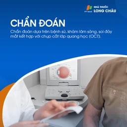 Màng trước võng mạc 5