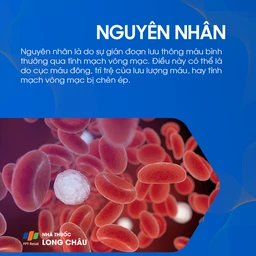 Tắc tĩnh mạch võng mạc 3