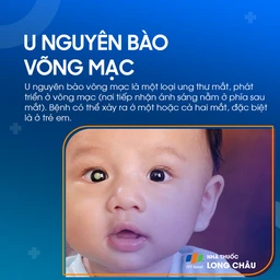 U nguyên bào võng mạc 1
