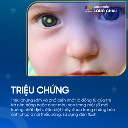 U nguyên bào võng mạc 2