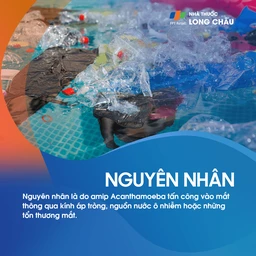 Viêm giác mạc do Acanthamoeba 3