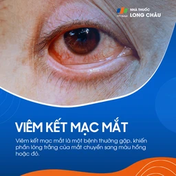 Viêm kết mạc mắt 1
